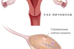 Схема рака яичников