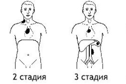 Стадии неходжкинской лимфомы