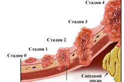 Стадии развития рака желудка