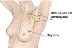 Схема рака молочной железы