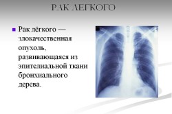 Рак легкого